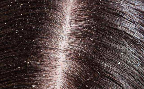 ͷƤм����ʲôԭ�� ʲôԭ����ͷƤм����